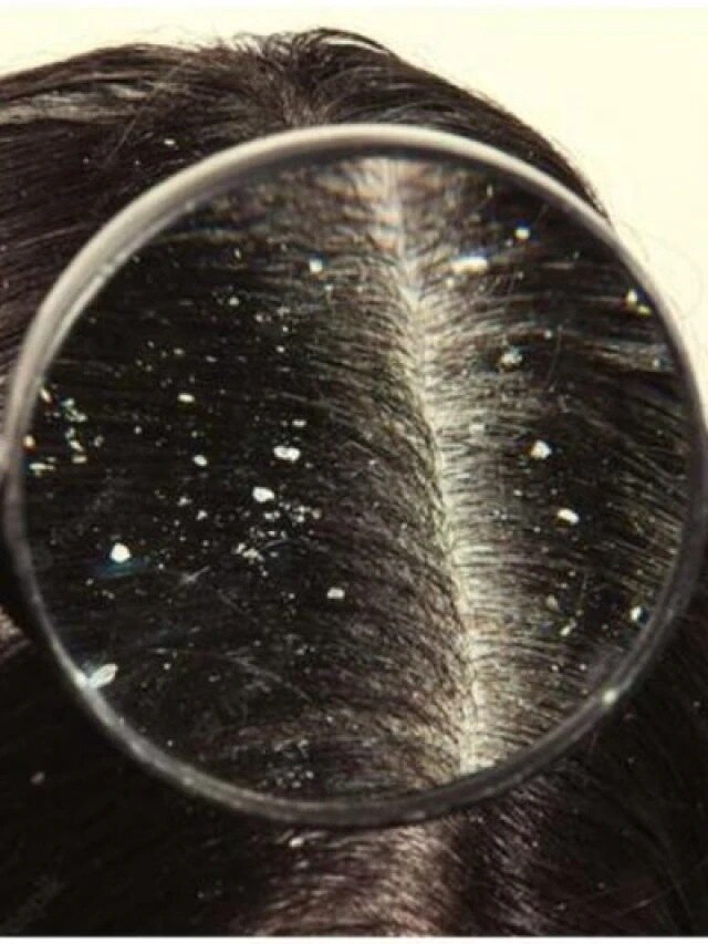 বর্ষায় বাড়ছে খুশকির সমস্যা, টাক হওয়ার আগেই করুন এই কাজ