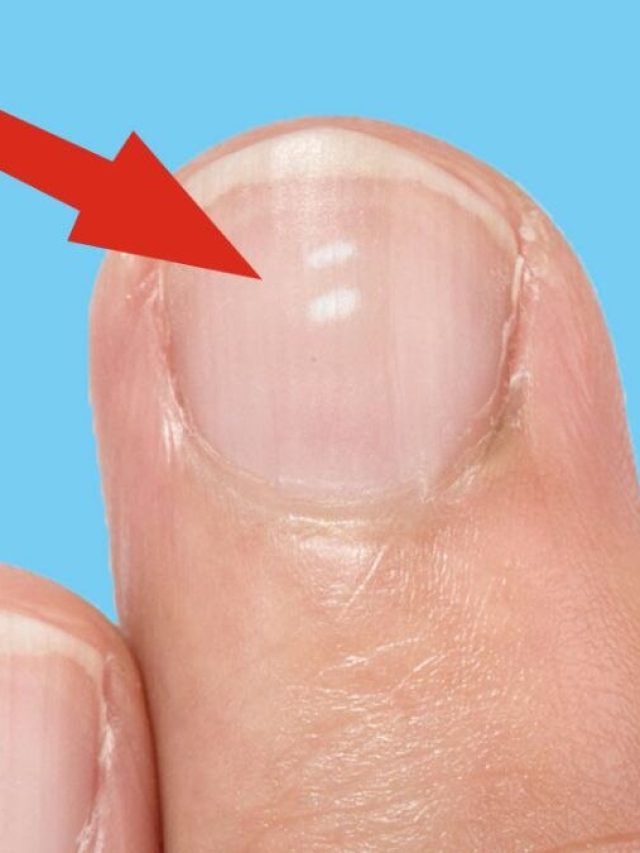 নখে কি এরকম সাদা দাগ দেখা যাচ্ছে, কীসের ইঙ্গিত জানেন?