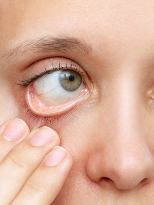 महिलाओं में क्यों होती है आयरन की कमी? इन टिप्स को करें फॉलो