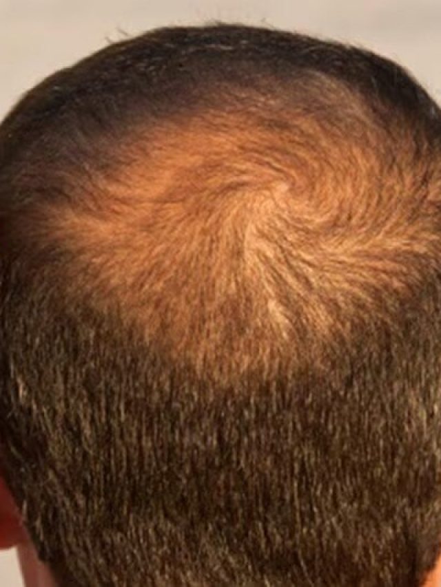 क्या तेजी से झड़ रहे हैं आपके बाल? हो सकती है इस विटामिन की कमी