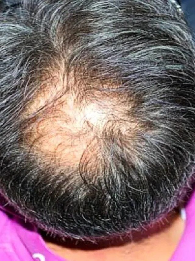 টাক মাথা ভরবে কালো চুলে, শুধু  লাগান এই সবজির রস