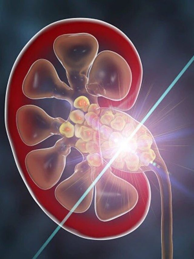 কিডনিতে পাথর তৈরি করে এসব খাবার,  খেলেই স্টোন হবে