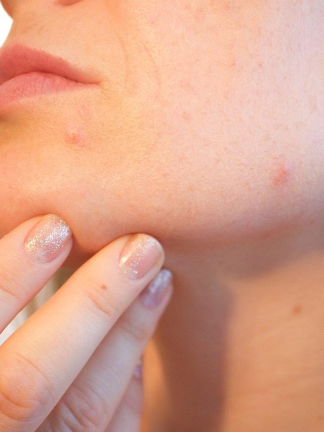 चेस्ट, पीठ और कंधे के एक्ने से हैं परेशान? इन तरीकों से मिल सकता है फायदा