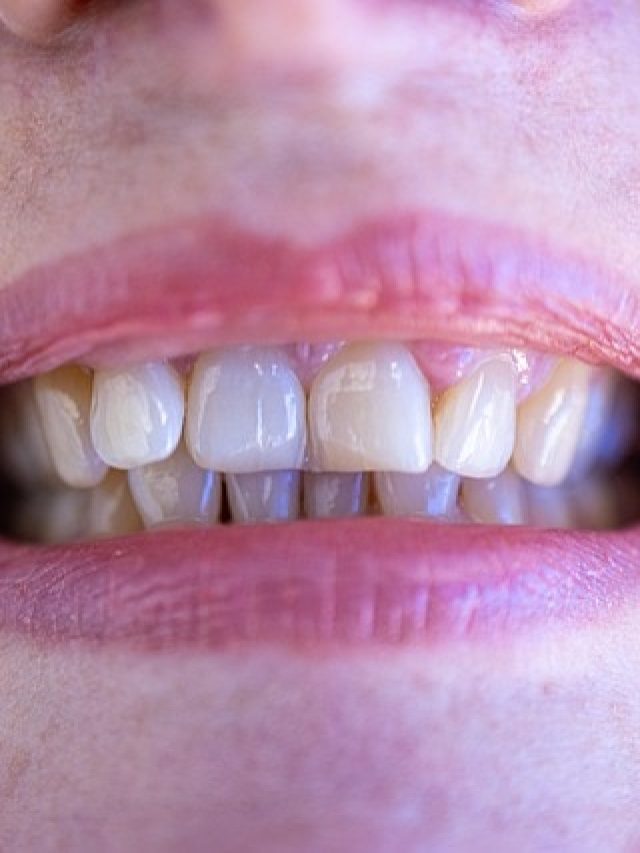 पीले दांतों करना चाहते हैं 'मोती' जैसे सफेद, इन घरेलू उपायों को अपनाएं