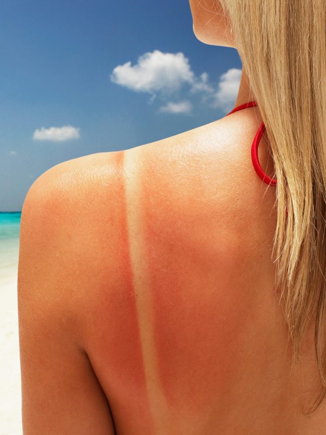 तेज धूप से झुलस गई है आपकी स्किन? किचन में रखी इन चीजों से फिर ठीक करें त्वचा