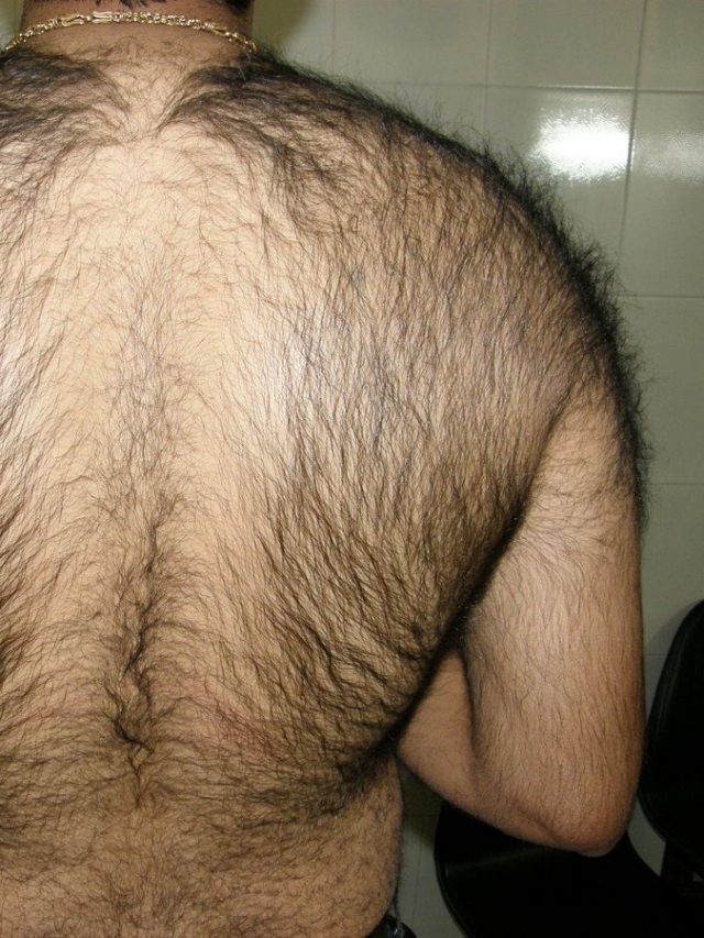 পিঠে গোছা গোছা লোম, কিসের ইঙ্গিত, জানুন