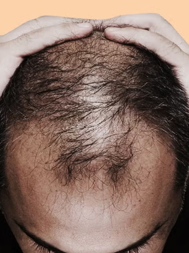 এই ৫ খাবার খেলেই চুলে পড়ে মাথা হয় গড়ের মাঠ