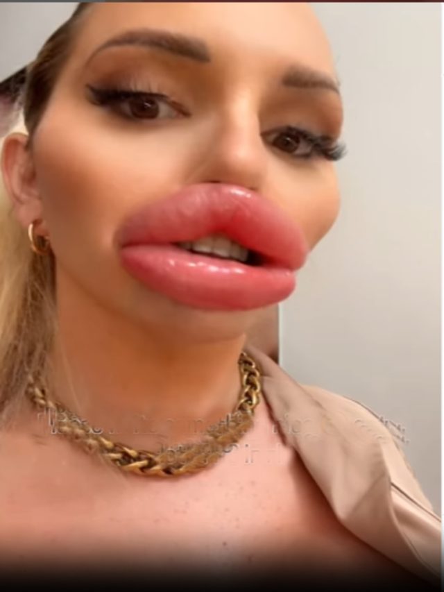 'मोमो जैसे होठों' के लिए खर्च किए 1.45 करोड़, खुद बताया अब हो रहीं कौन सी दिक्कतें