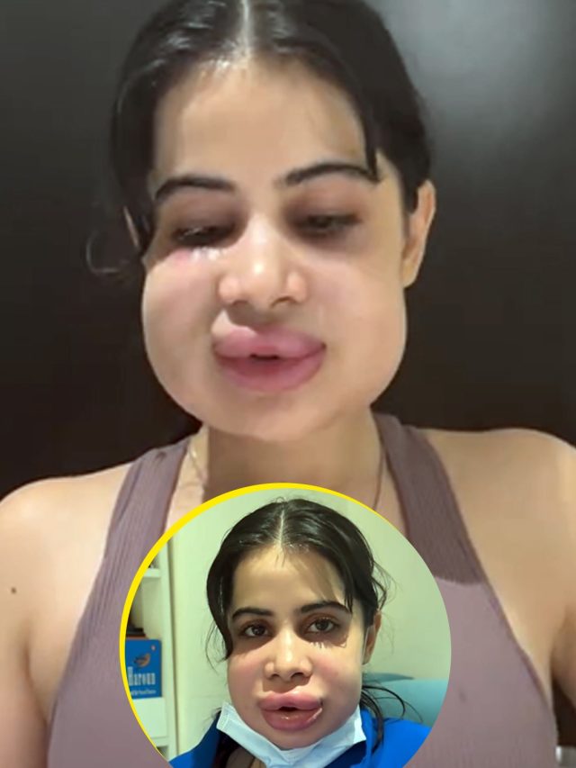 फूला चेहरा-सूजे होंठ, बिगड़ा एक्ट्रेस का चेहरा, बोलना हुआ मुश्किल, बोली- मेरे बॉयफ्रेंड ने...