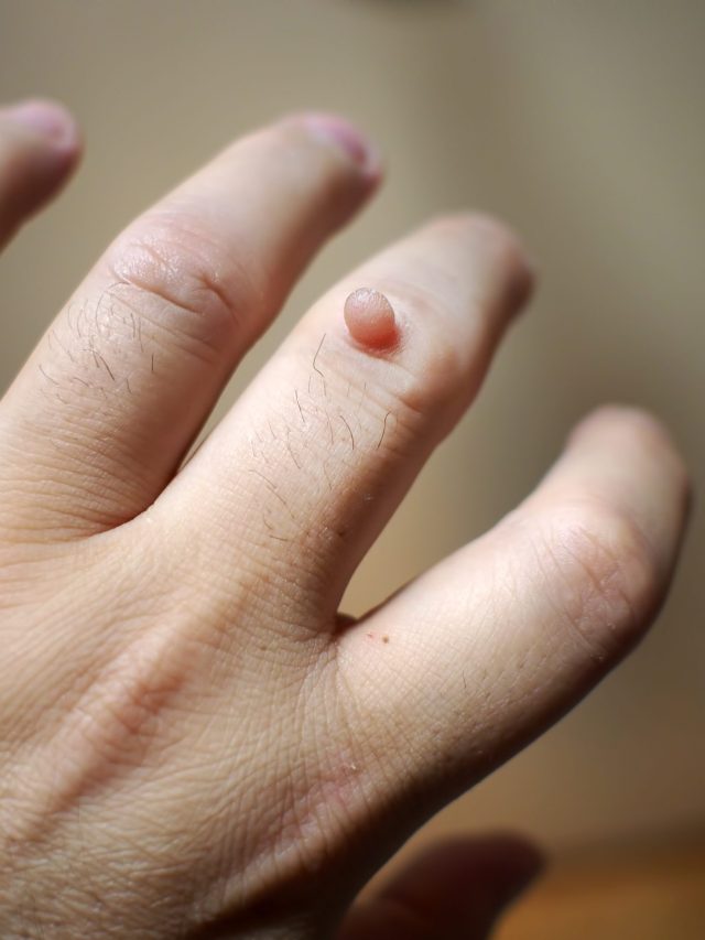 আঁচিল নিজে থেকেই পড়ে যাবে,  এই ফলের খোসা ঘষে দেখুন