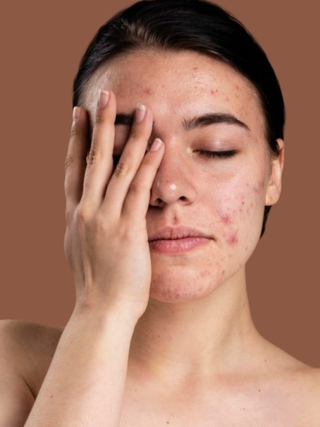 पिंपल और दानों से भर गया है चेहरा तो डाइट में शामिल कर लें ये ड्रिंक्स, स्किन होने लगेगी साफ