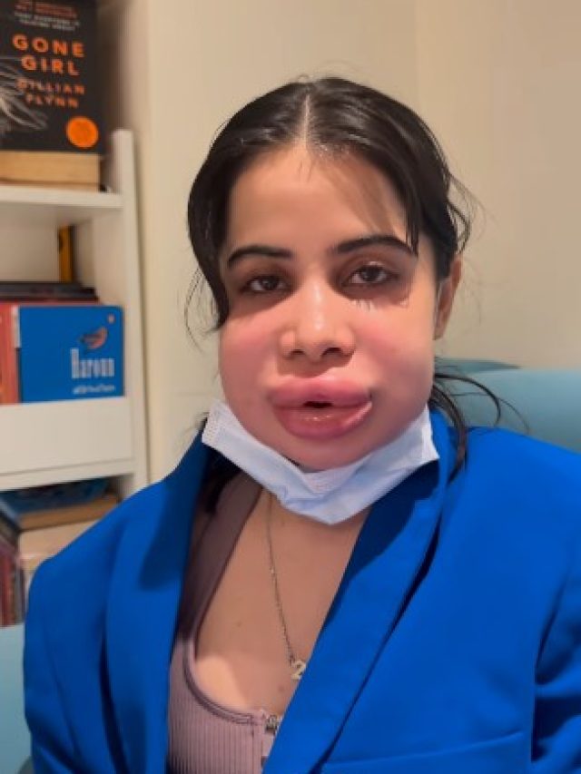 'गुब्बारे' की तरह फूला एक्ट्रेस का चेहरा, 46 की उम्र में पापा बना मशहूर एक्टर