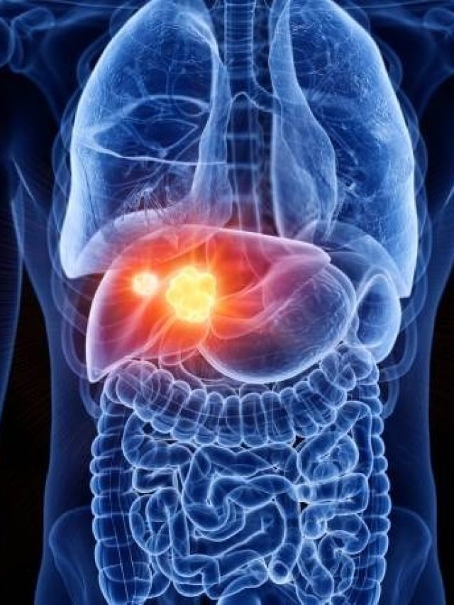 लिवर के लिए 'जहर' से कम नहीं ये 5 खाने की चीजें, लगातार सेवन पर सड़ने लगेगा Liver