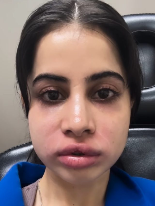 उर्फी जावेद ने लगवाए दर्दनाक इंजेक्शन्स! सूजे होंठ, बोलीं- 18 की उम्र से...