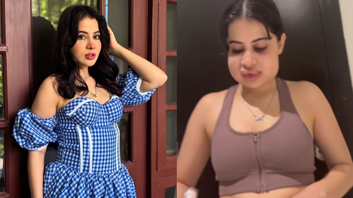 उर्फी जावेद का शॉकिंग ट्रांसफॉर्मेशन, हटवाए लिप फिलर्स, दिखाया 'असली चेहरा'