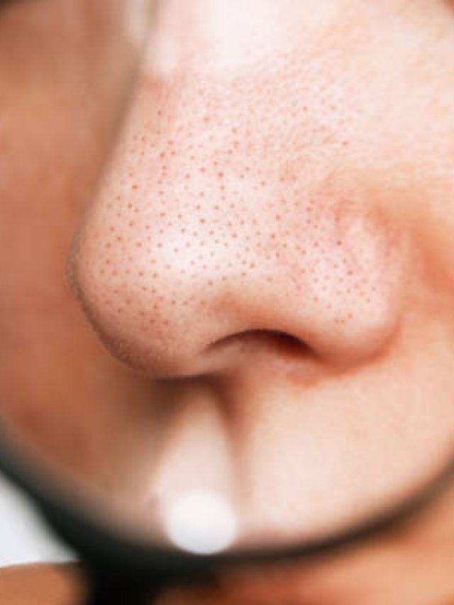 পুজোর আগে নাক ভর্তি ব্ল্যাক হেডস দূর করুন এই সহজ উপায়ে