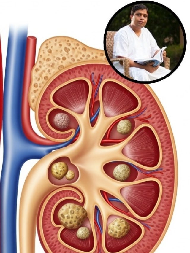 किडनी स्टोन से पाना है छुटकारा? आचार्य बालकृष्ण ने बताया आसान नुस्खा