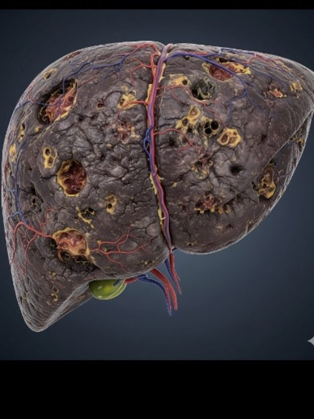 ये 3 फूड्स आपके लिवर को सड़ाकर कर सकते हैं फेल! AIIMS डॉक्टर ने दी चेतावनी