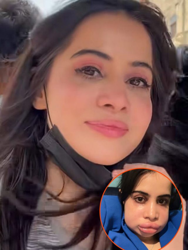 लि‍प फिलर बर्बाद न कर दे चेहरा! उर्फी का हुआ था ऐसा हाल, ल‍िखा दर्द