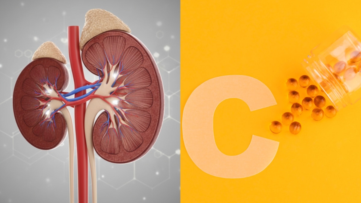 किडनी स्टोन का जोखिम बढ़ा सकती हैं विटामिन C की गोलियां, डॉक्टर ने दी चेतावनी