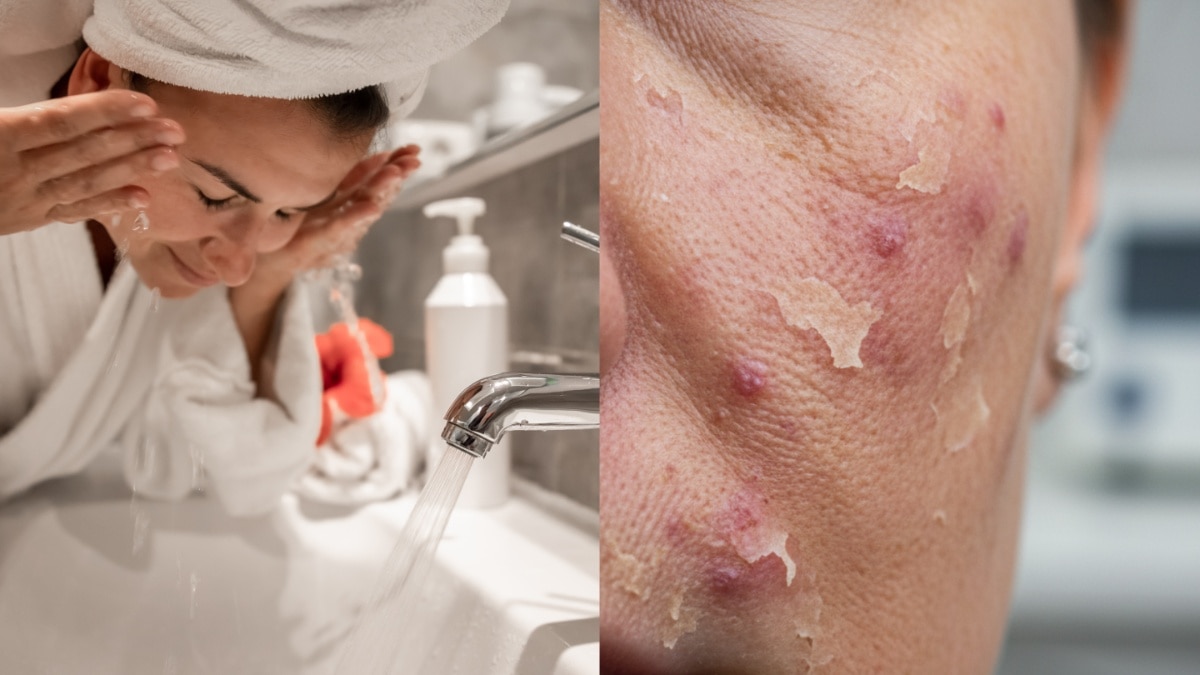 नल के पानी से चेहरे को धोने की न करें गलती, डॉ. नवजोत अरोड़ा ने बताए नुकसान