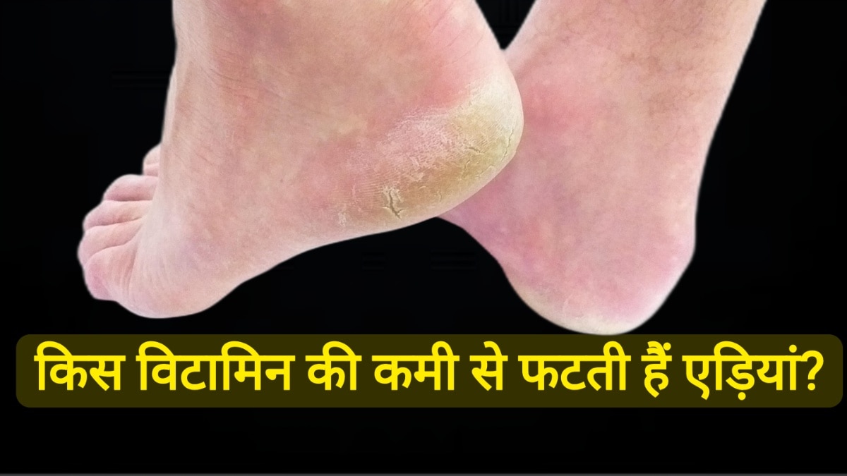 सिर्फ ठंड नहीं, इन विटामिन्स की कमी से भी फटती हैं एड़ियां! जानिए