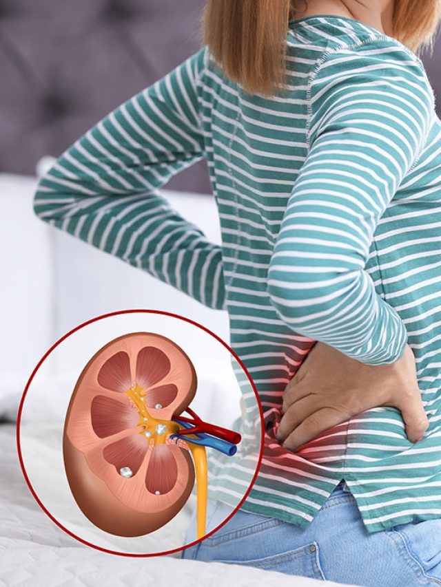 The cold-season mistake doctors say is fueling painful kidney stones