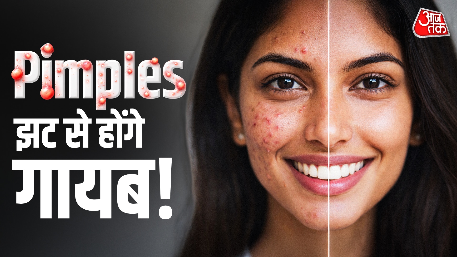  Pimples से पाना है छुटकारा? डॉक्टर ने बताएं देसी नुस्खे